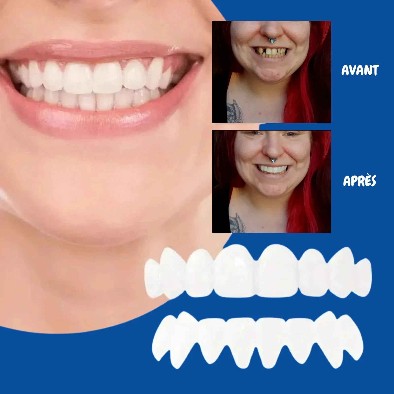 Schneider Facettes dentaires souples à clipser – Sourire immédiat sans douleur
